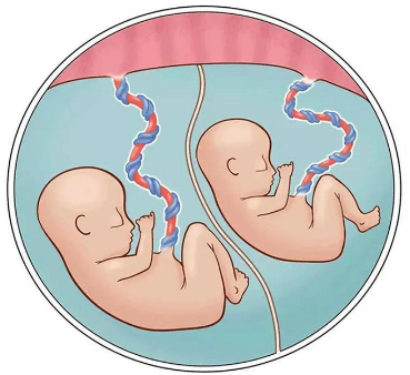 试管双胎预防早产从7个方面入手